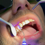 Limpieza dental Láser